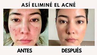 HOW TO REMOVE ACNE WITH ADAPALENE OR ADAPALENE, HOW TO ELIMINATE ACNE? my acne routine