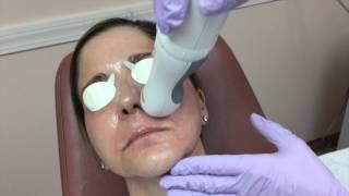 ICON 1540 Laser Demonstration | The Langdon Center for Laser & Cosmetic Surgery