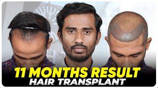 Hair Transplant in Hubli | Best Results & Cost of Hair Transplant in Hubli