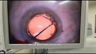 Optic capture technique for dislocated sulcus IOL