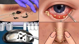 ASMR Satisfying Care Animation‼️, Eye Stone, Navel Stone Removal, Blackhead Care, Make up