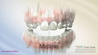 Midline Shift Due to Blocked Out Teeth - Orthodontic Treatment