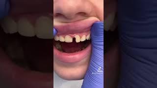 #tiktok #video #dentist #fyp #viral #foryou #love #broken #teeth #blogger#dental #crown