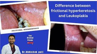 DIFFERENCE BETWEEN FRICTIONAL HYPERKERATOSIS AND LEUKOPLAKIA