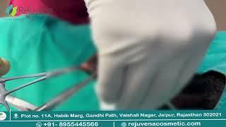 Circumcision Surgery in Jaipur | Rejuvena Cosmo Care by Dr. Deepesh Goyal