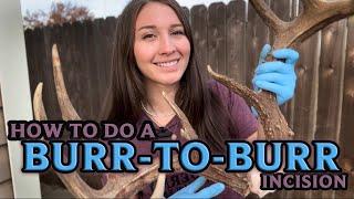 How to do a Burr to Burr Incision