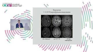 Нейрохирургия у пациентов с метастазами меланомы в головной мозг: какие задачи мы решаем?