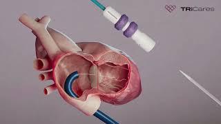 Topaz tricares Heart catheter deploy