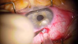 AcrySof Cachet Implantation, Prof. Scheider.wmv