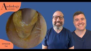 MYSTERY OBJECT REMOVAL FROM A PATIENTS EAR - EP741