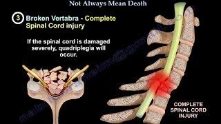 Cervical spine fracture,neck fracture - Everything You Need To Know - Dr. Nabil Ebraheim