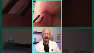 Doctor reacts to satisfying splinter removal! #dermreacts #doctorreacts #splinterremoval