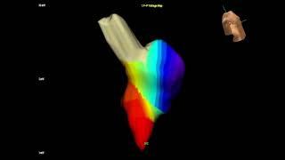 3D Electroanatomic Map of Typical Atrial Flutter