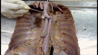 Anatomy Dissection of Mediastinum and Thoracic Wall