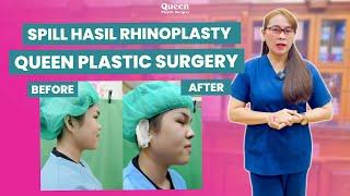 Spill Hasil Rhinoplasty Di Klinik Bedah Plastik Queen, Hidung Impian Jadi Nyata? | MUST WATCH