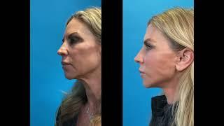 Advanced Facelift Dynamic Photos from Advanced Facelift Before & Afters