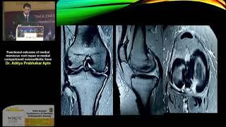 Functional outcome of medial meniscus root repair in medial ...- Dr. Aditya Prabhakar Apte