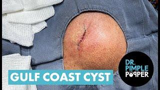 Dr Pimple Popper Opens The 'Gulf Coast' Cyst
