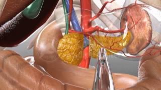 Pancreatic tail resection