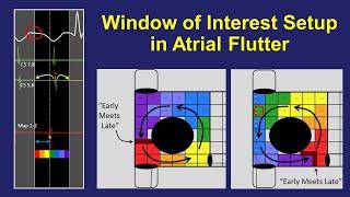 Window of Interest Setup for Atrial Flutter