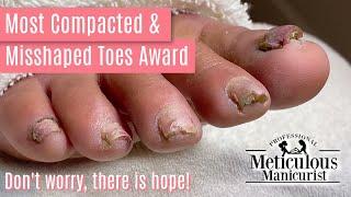 How to Pedicure Transformation the Most Compacted & Misshapen Toenails