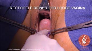 Rectocele Repair at Vaginoplasty for Vaginal Laxity