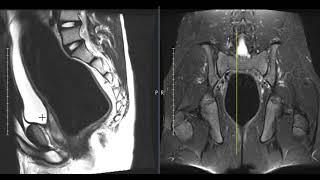 Fecal impaction