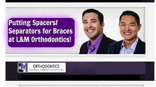 Putting Spacers/ Separators for Braces