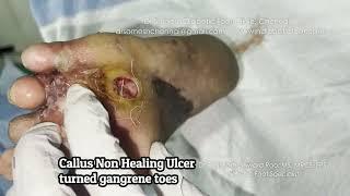 #nonhealingulcer  before after ball of foot region #diabeticfoot