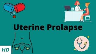 Uterine Prolapse, Causes, Signs and Symptoms, Diagnosis and Treatment.