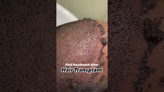 First Head wash after Hair Transplant | Hair Specialist in Delhi  | DMC Trichology | Dr.Nandini Dadu