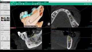 Software Ez3D-i : Inserimento impianto e esportazione stl