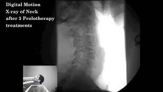 Digital Motion X-ray before and after Prolotherapy