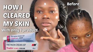 THE TRETINOIN NIGHT ROUTINE THAT CLEARED MY SKIN | Step by step Tretinoin routine #tretinoin