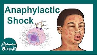 Anaphylactic shock | Anaphylactic Reaction: Symptoms and Treatment