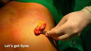 Gynecomastia Surgery At Bliniq Cosmetic Surgery Centre I Dr Ashwani Kumar, Plastic Surgeon