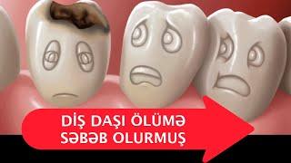 Diş daşı ölümə səbəb olurmuş