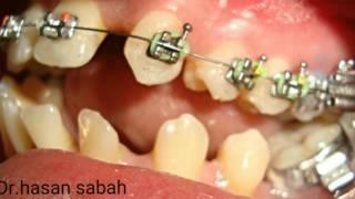 Dr.hasan sabah..orthodontic treatment of generalized spaces&anti.&posti.open bite &congi.missing U.2