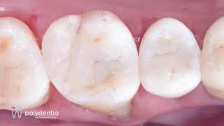 Class II's restoration with diamond24 and myRing classico clinical case