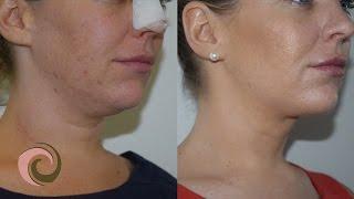 Face & Neck Liposuction for a Defined Jawline // PATIENT BEFORE & AFTER