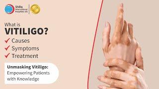 Understanding Vitiligo | Symptoms, Diagnosis, and Treatments