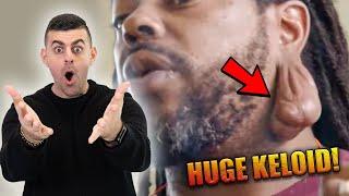 Reacting To HUGE KELOID!! *Warning Pus*