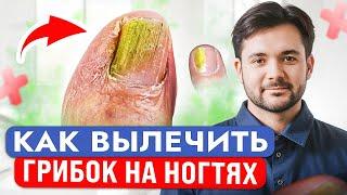 Этот СПОСОБ 100% Убьет Всех Паразитов на Ваших Ногтях! Как Вылечить Грибок Дома?