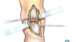 PreOp® Patient Education: Achilles Tendon Repair Surgery