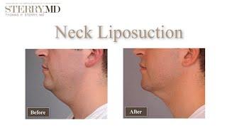 Am I a good candidate for Neck Liposuction?