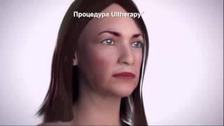 Механизм действия Ultherapy: клиника Юлии Щербатовой