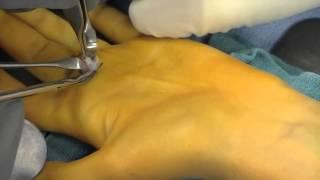 Ganglion Cyst of Tendon Sheath Surgery by Dr. Thomas Trumble