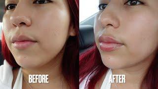 MY LIP FILLER EXPERIENCE  | getting my lips done for the first time!