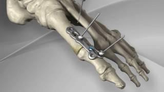 First Metatarsophalangeal Joint Fusion with Arthrex® MTP Fusion Plate