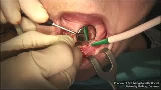 GC Tech.Europe - Implant placement